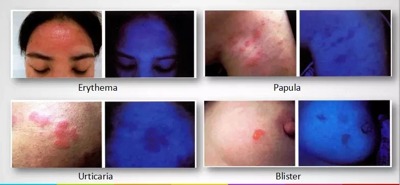 Wood&prime;s Lamp UVA Black Light Dermatitis Diagnose Skin Analyzer Price