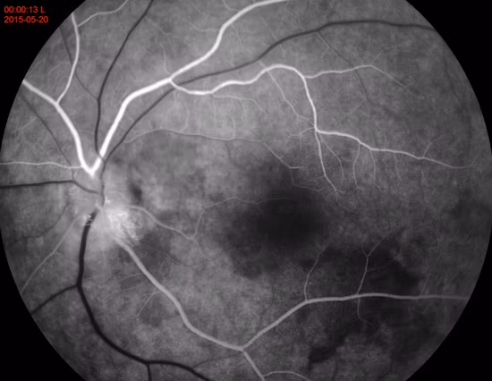 Fundus Camera&Ffa Model PT